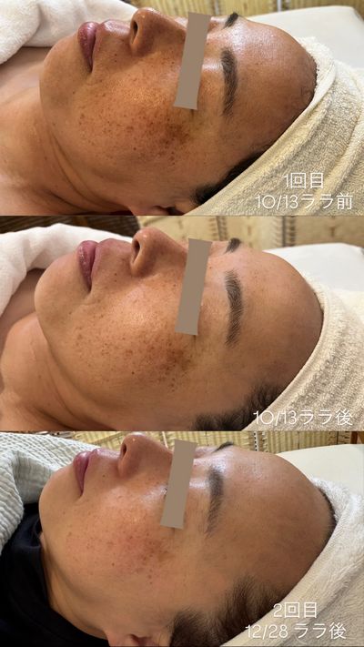 ララピーリング